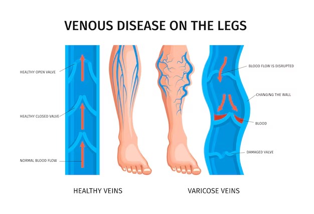 understanding-varicose-veins:-causes,-symptoms,-and-treatments